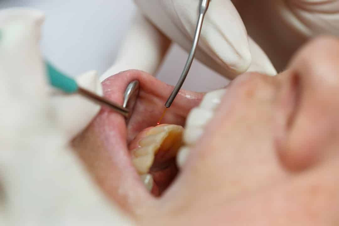 Laser dentistry, working on a patient with the help of a CO2 Laser