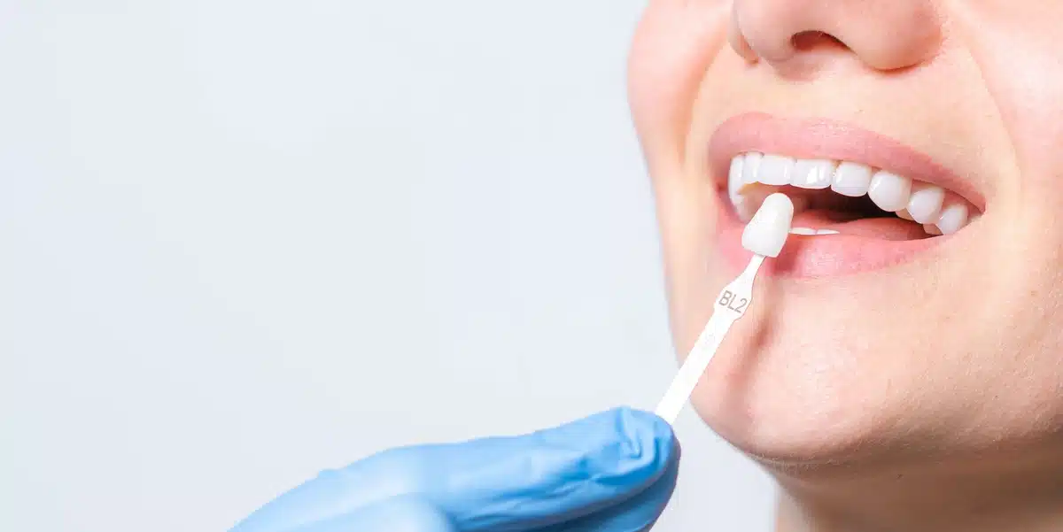 Close-up of a patient matching tooth color for a dental veneer, showing a common type of veneers used in cosmetic dentistry.