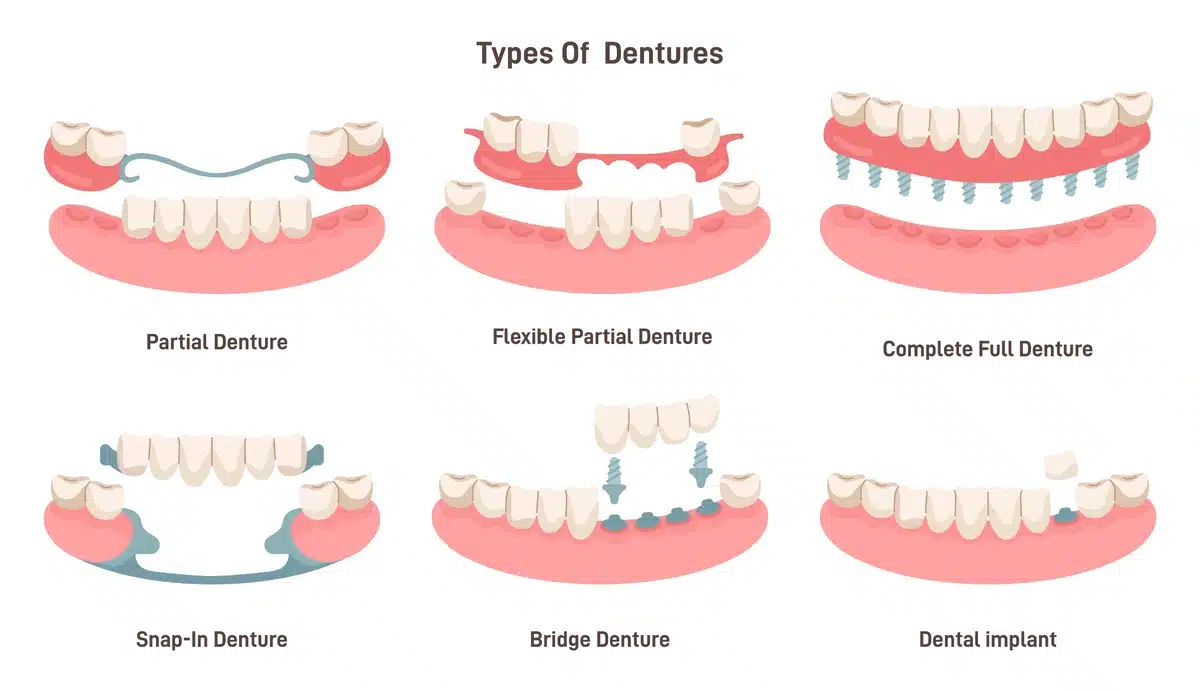 diagram with different types of dentures to assess pain