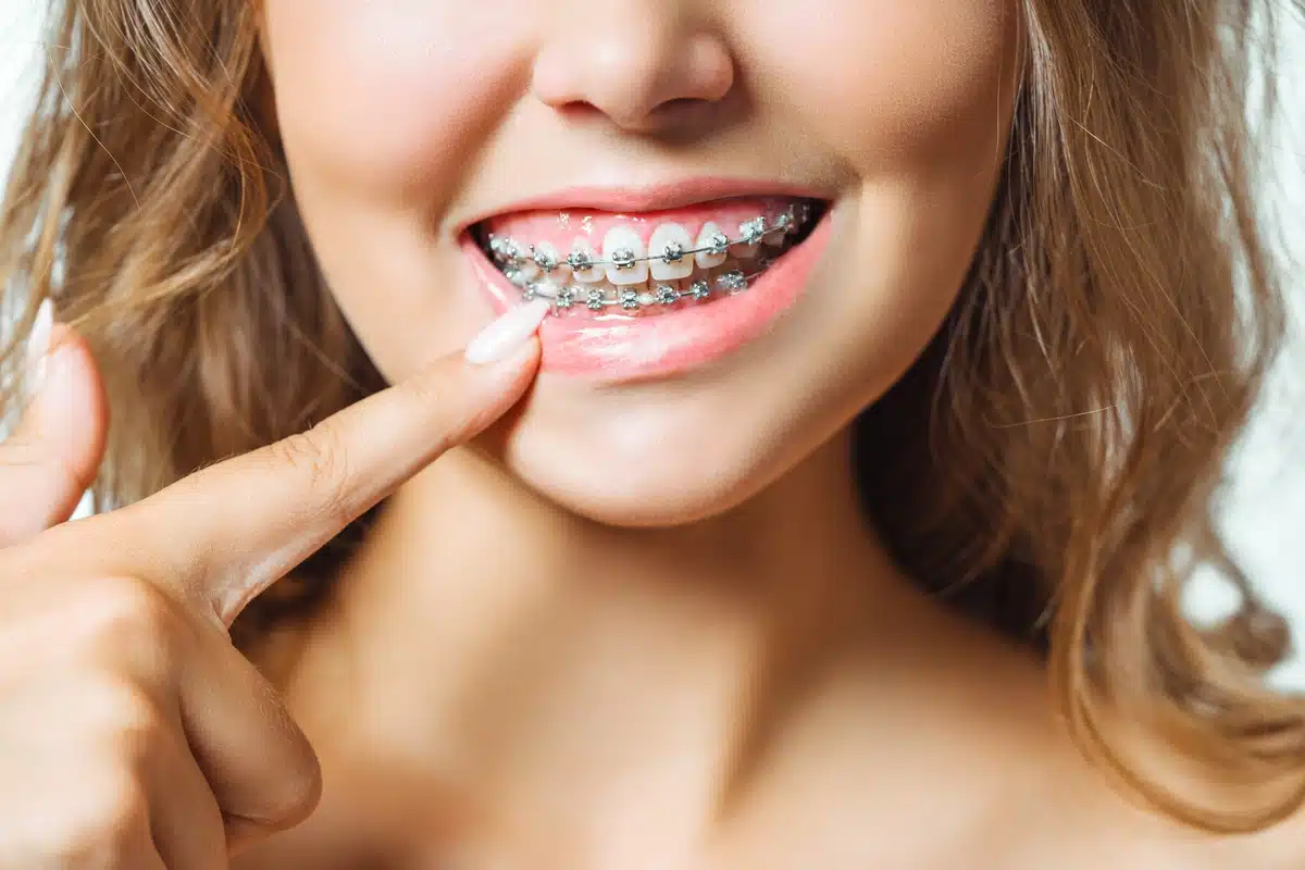 woman with new braces pointing at them