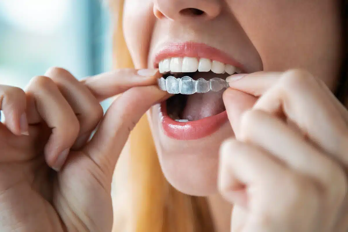 aligners