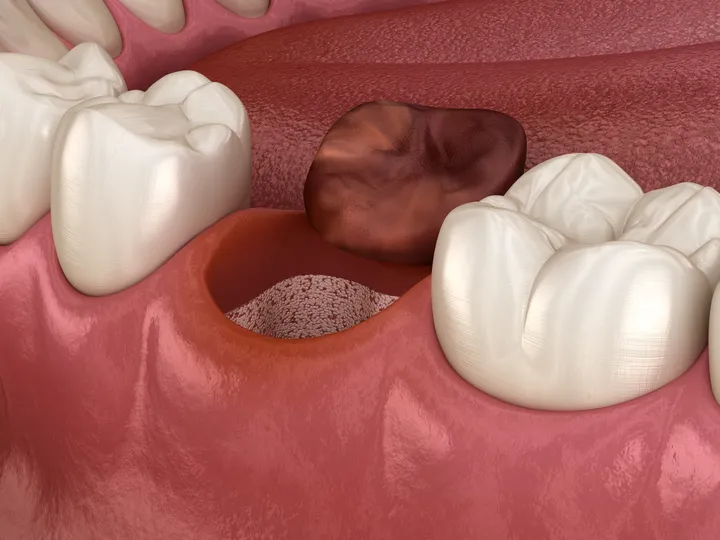 dry tooth socket