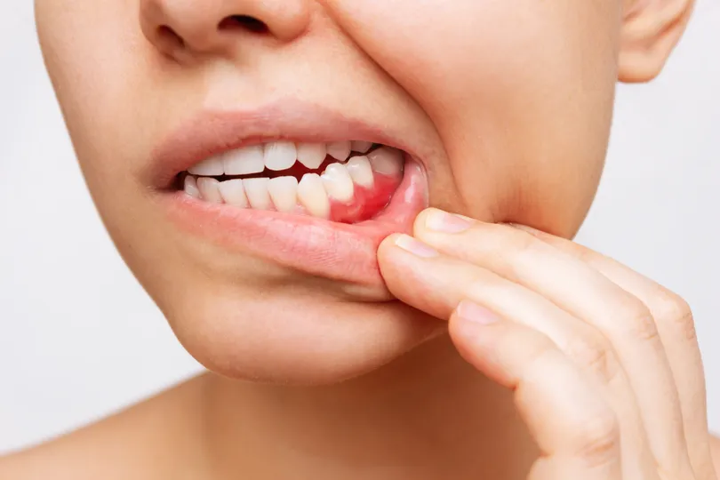 swollen gums around teeth