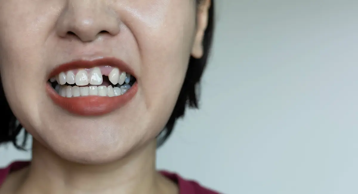 tooth loss
