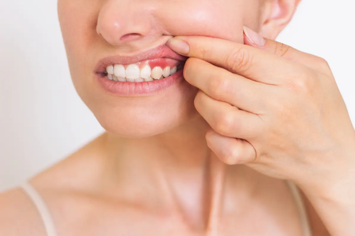 periodontal disease