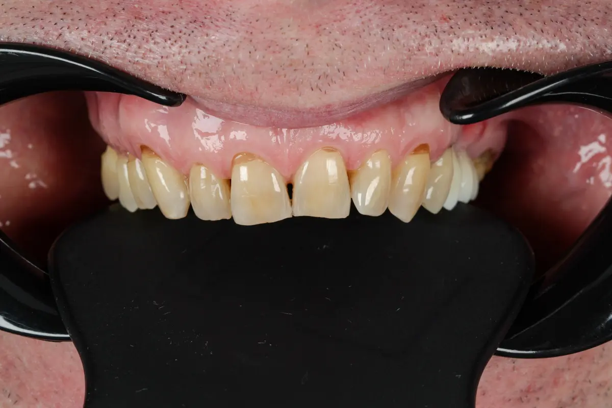 receeding gums