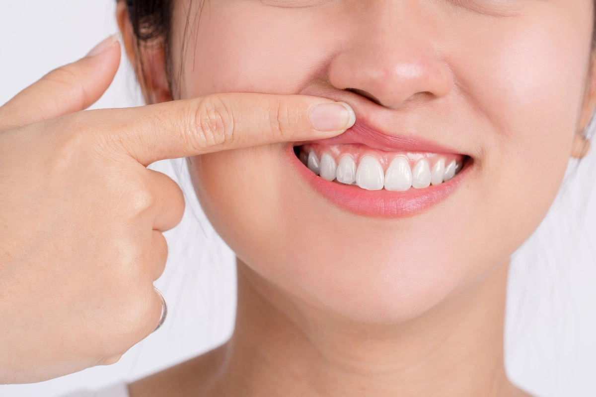 A person is holding up their upper lip with a finger, revealing a wide smile and white teeth. The background is plain and light-colored.