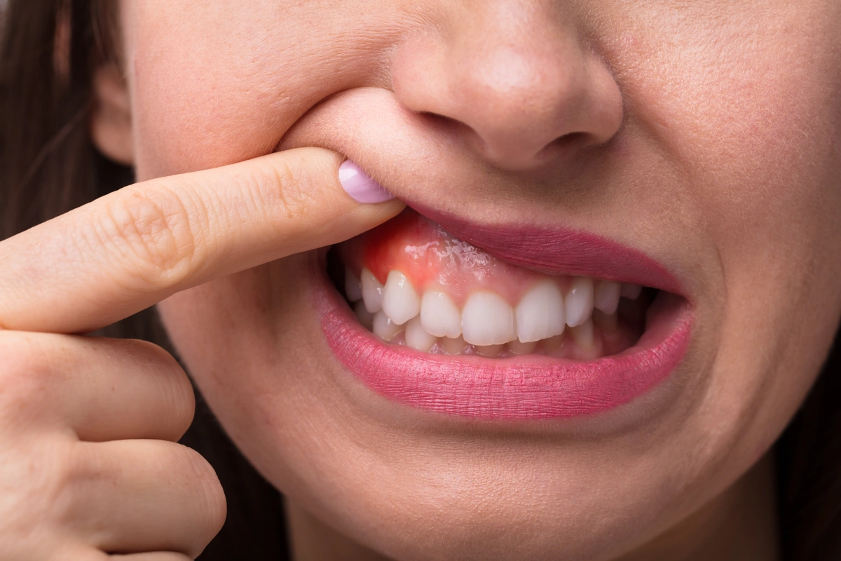 A person showing bruised gums with their finger, showing where it's more irritated.