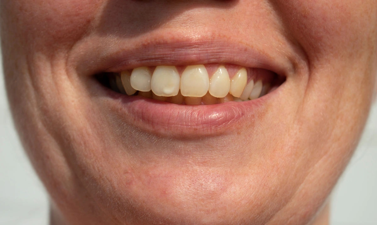 Close-up of a person smiling, showing their teeth and lips. The skin around the mouth is visible, displaying a natural complexion. The image captures the texture of the skin and the natural alignment of the teeth.