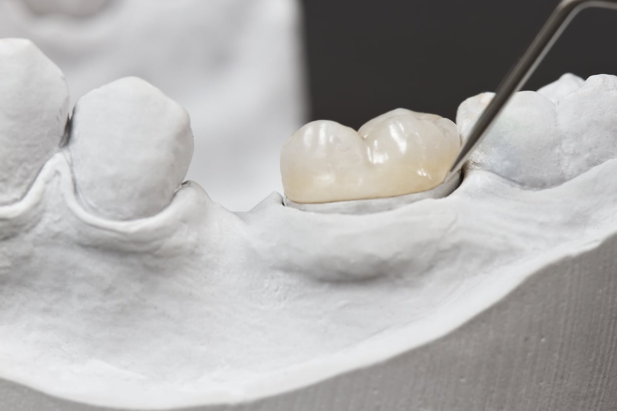 A close-up of a dental model showing a metal tool placing a ceramic dental crown onto a tooth, demonstrating dental restoration work.