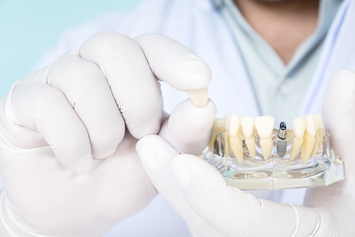 A person wearing white gloves holds a dental implant model and a single artificial tooth, demonstrating dental procedures or tooth replacement options.