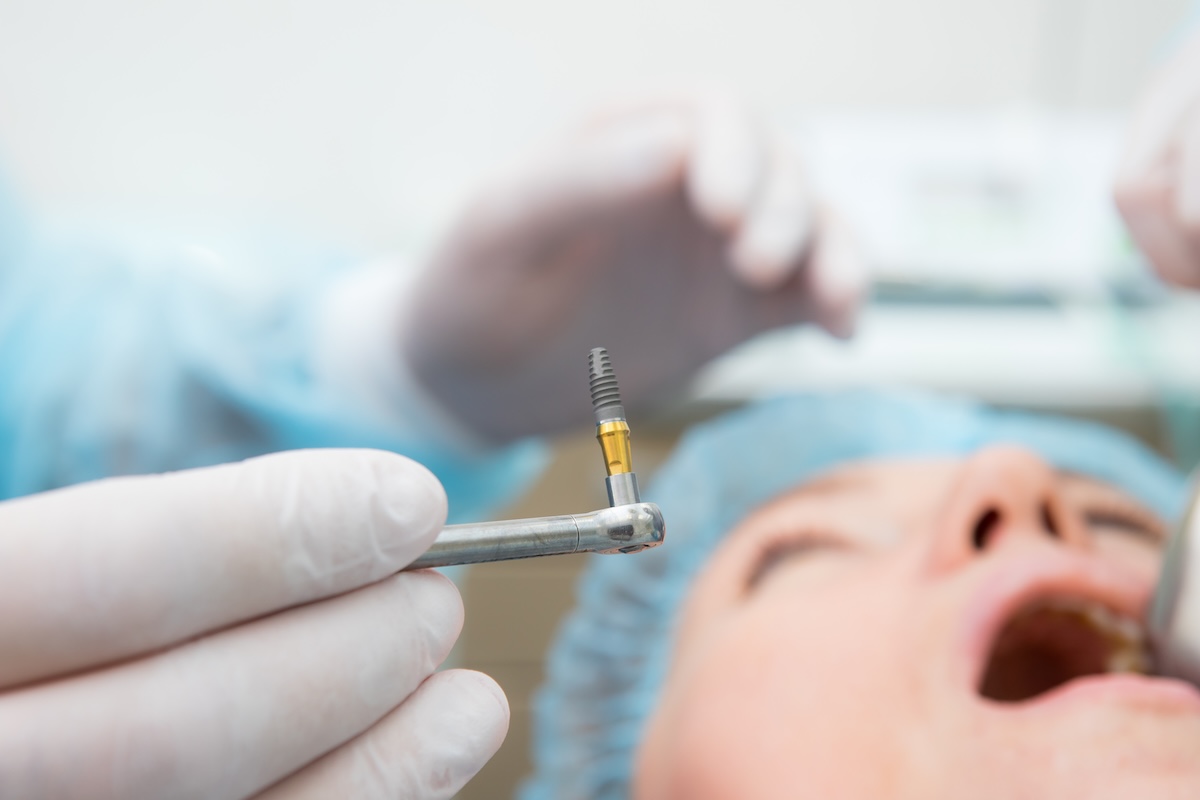 A dentist in gloves and a blue cap holds a dental implant tool near a patient’s open mouth during a dental procedure. The patient is lying down, and the focus is on the implant tool in the foreground.