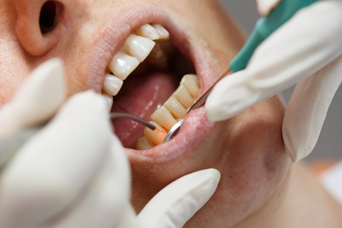 A close-up of a person receiving dental treatment using a laser tool