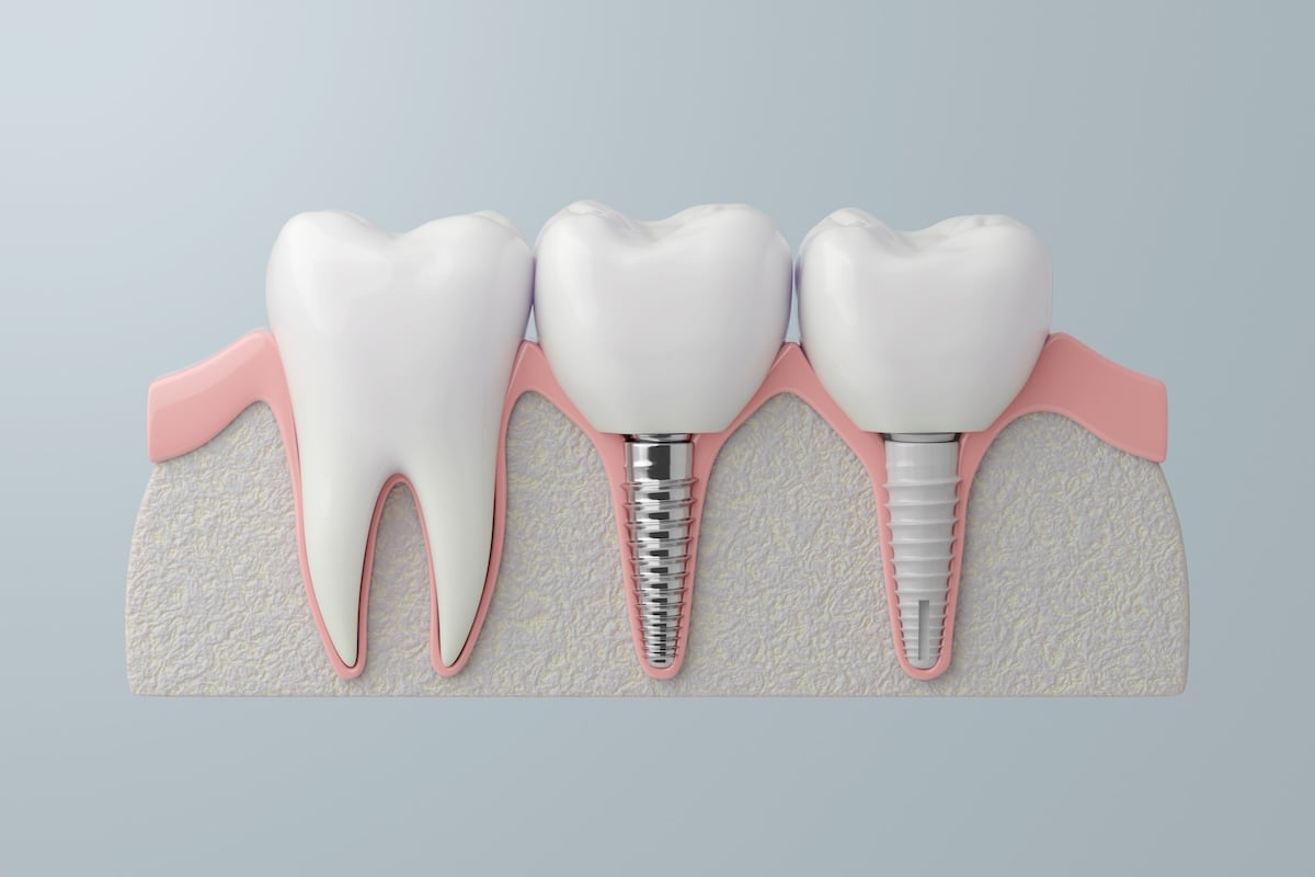 Cross-section illustration of three teeth: a natural tooth on the left and two dental implants on the right, one ceramic and one titanium