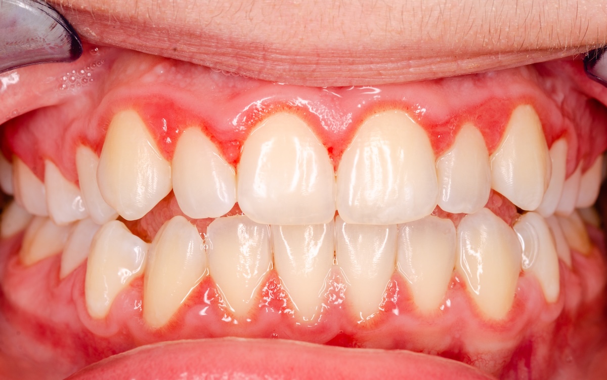 Close-up of a person's mouth showing teeth and gums. The gums appear red and swollen, possibly indicating inflammation or gingivitis