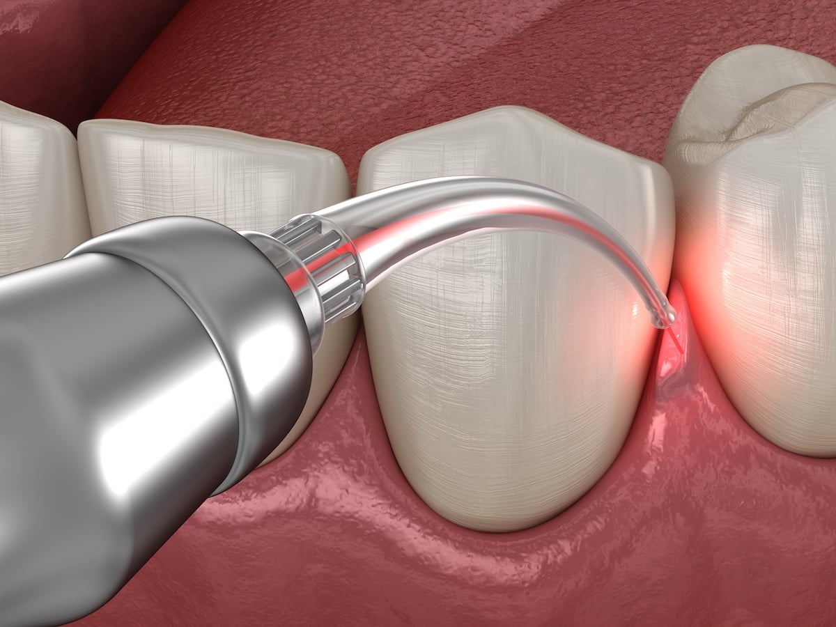 Gum correction surgery with laser. 