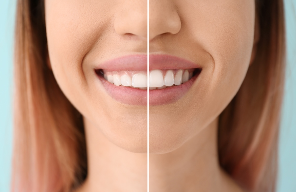 A close-up of a woman's smile, with the image split in half to show before and after of laser gum surgery