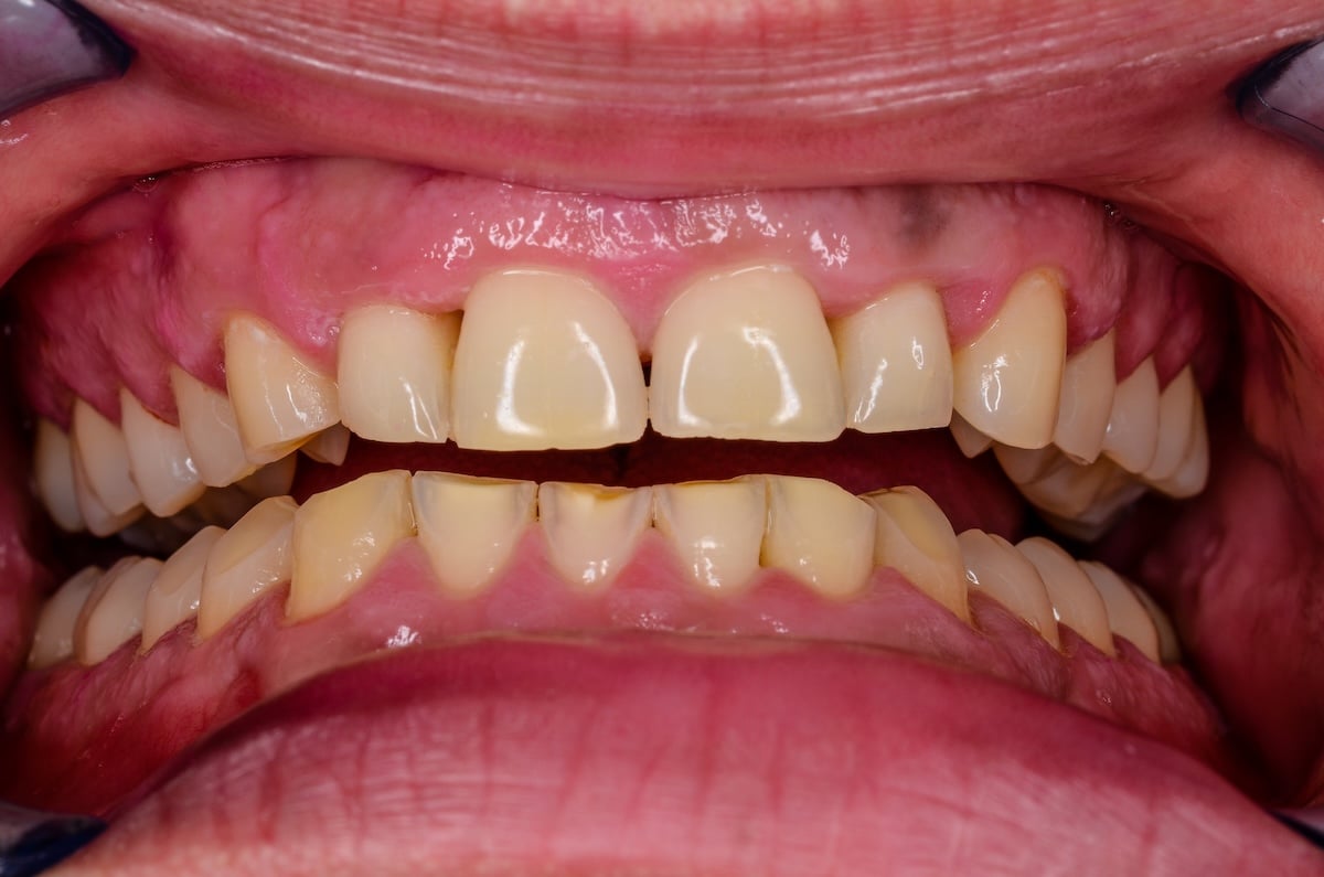 A close-up view of a person's open mouth shows upper and lower teeth with yellow discoloration, gum recession, and visible tooth wear