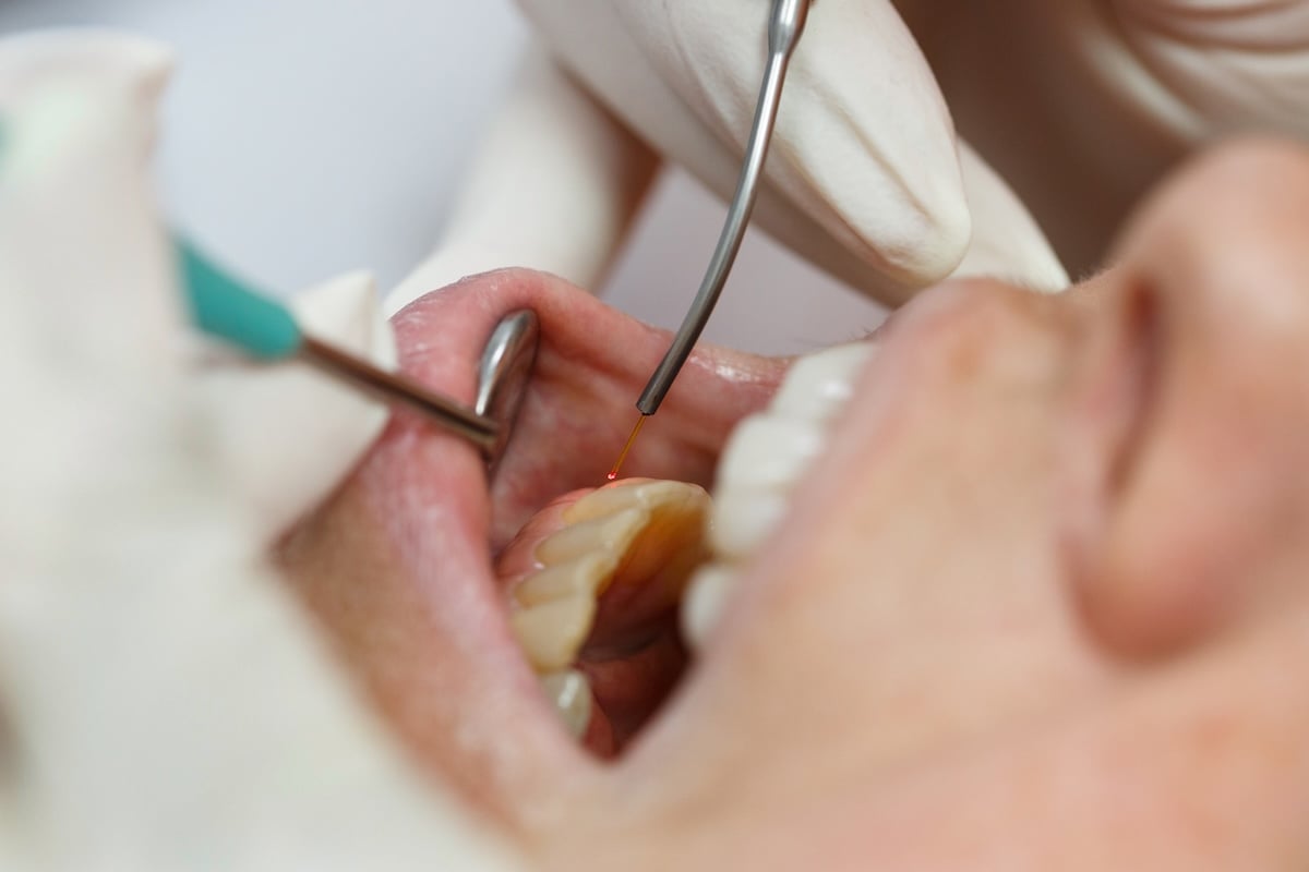 A close-up of a dental procedure shows a dentist using tools and a laser inside a patient’s open mouth
