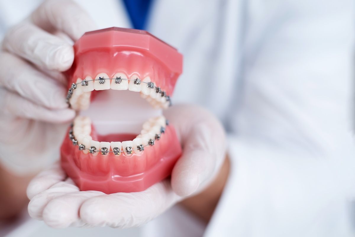 A person wearing white gloves holds a dental model showing upper and lower teeth fitted with metal braces
