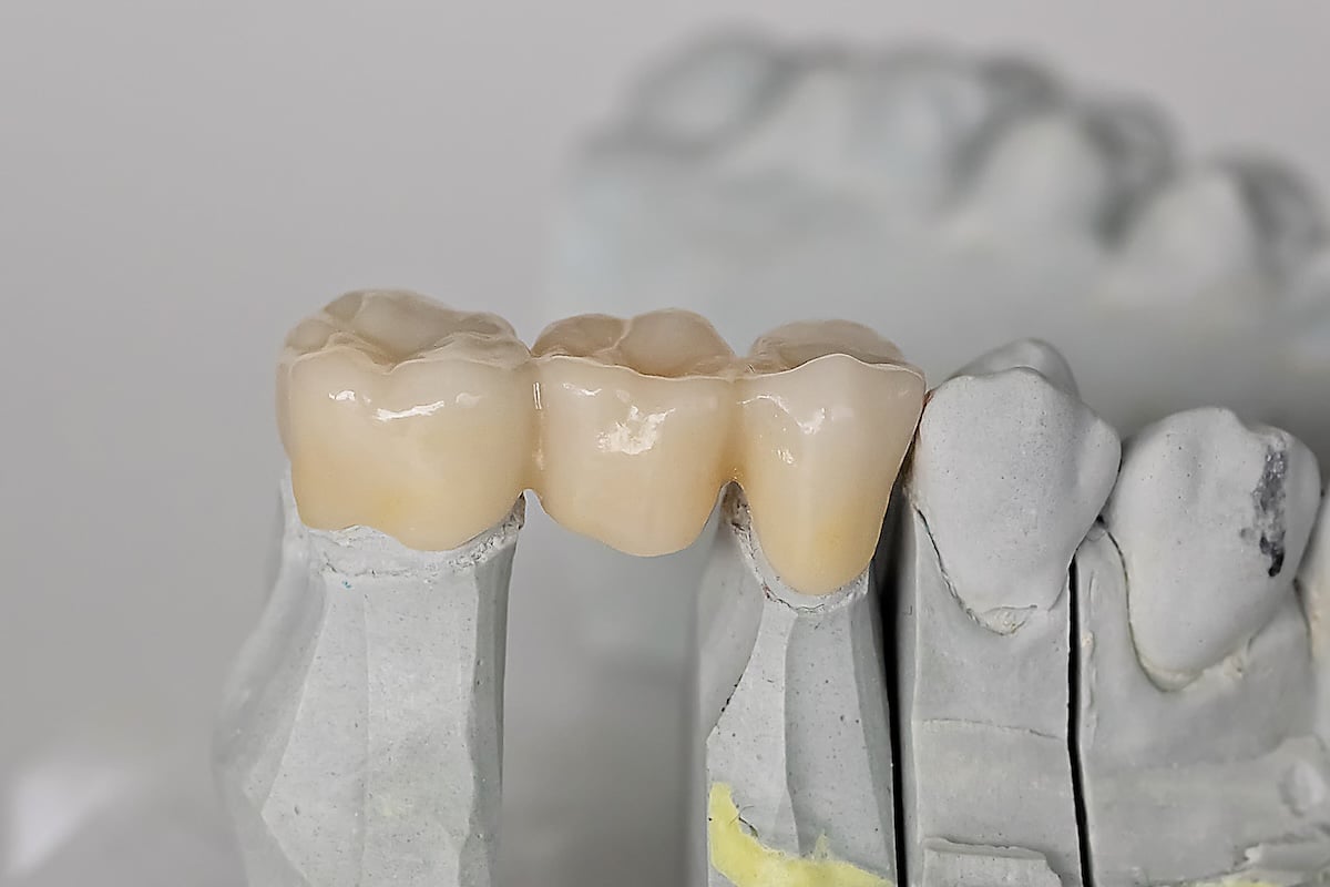 A close-up of a dental bridge model showing three artificial teeth connected