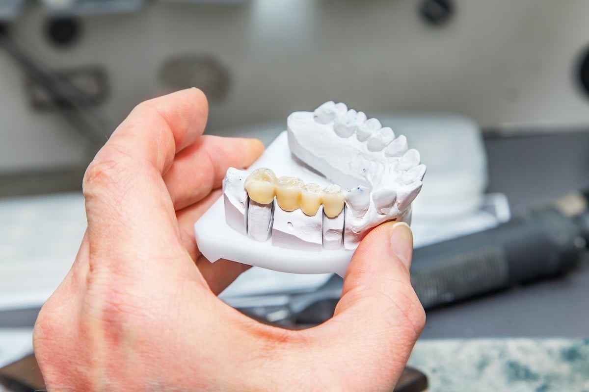 A hand holding a dental model showing several teeth, including a section with dental crowns or bridges fitted onto implants.