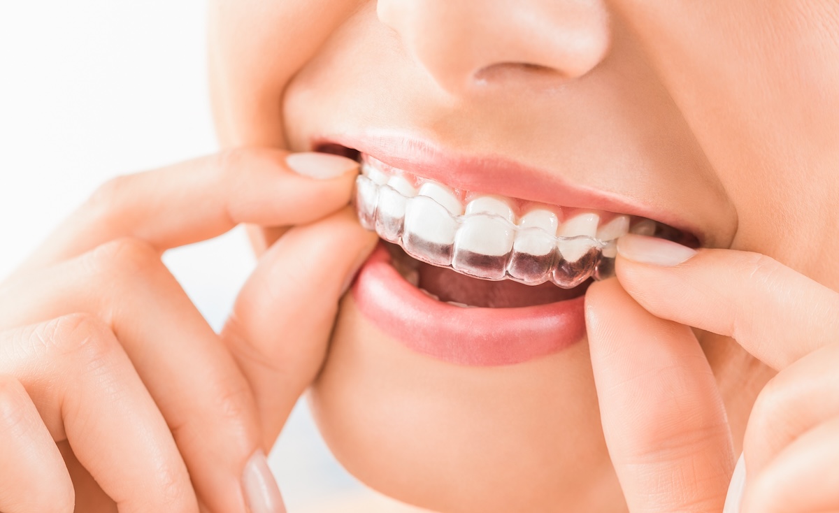 Woman wearing orthodontic silicone trainer. Invisible braces aligner. 