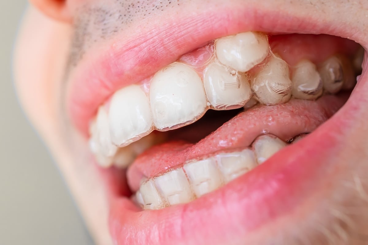 orthodontic invisible braces on crooked teeth close-up.