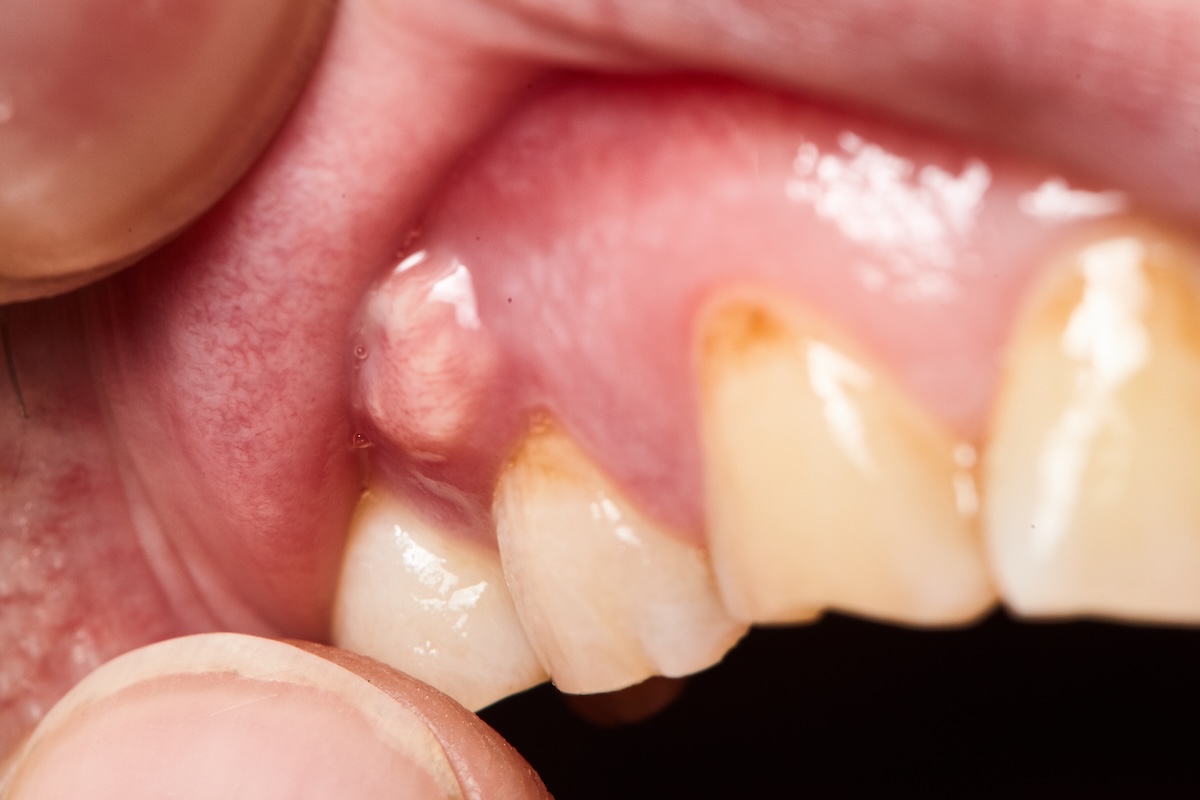 inflammation of the gums abscess closeup, teeth in poor condition with caries