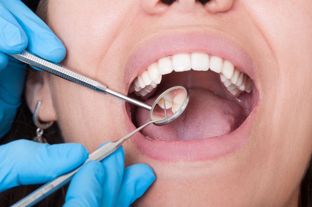 Closeup of dentist tools and mouth open with nice teeth