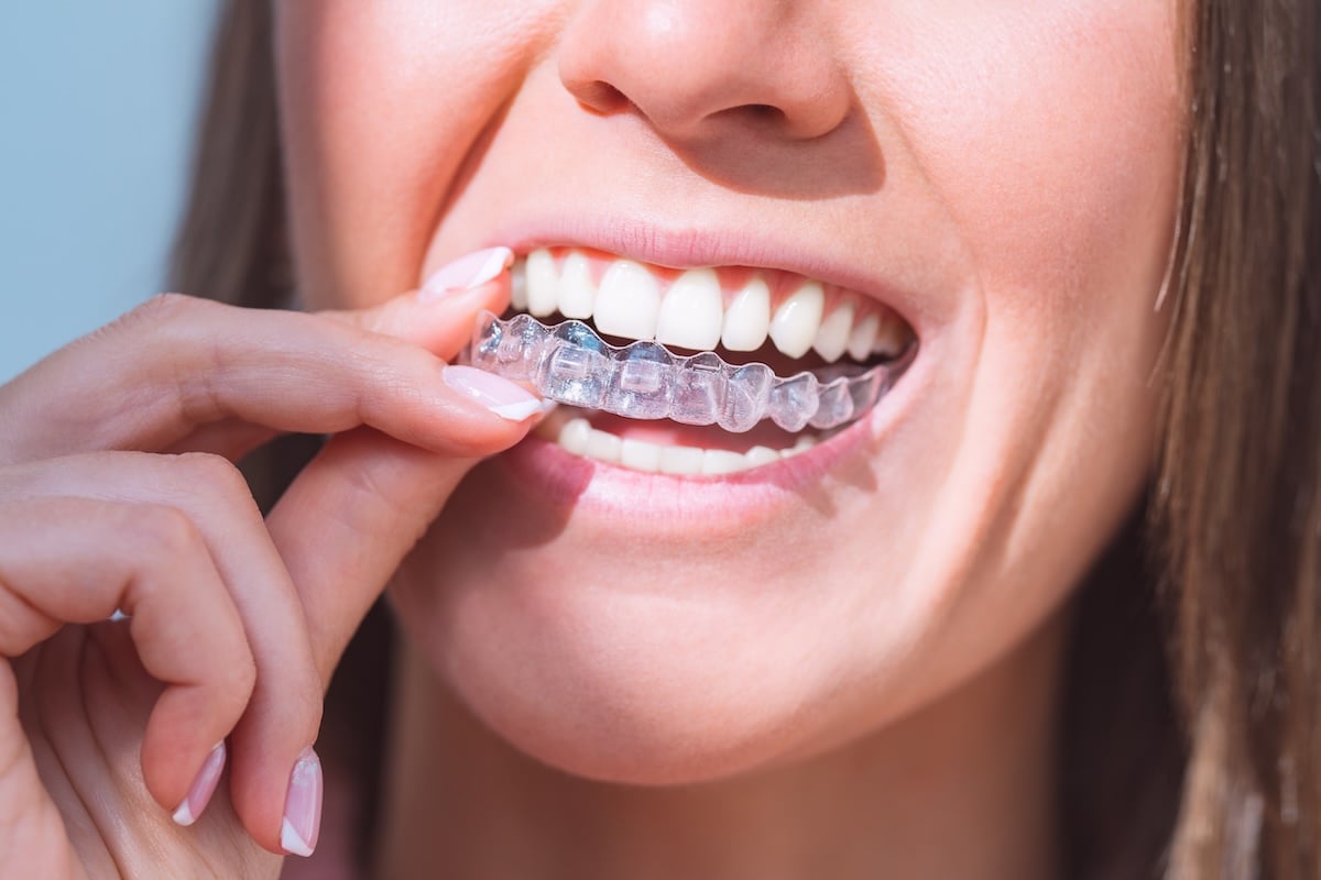 A close-up of a woman smiling as she inserts a clear dental aligner over her teeth with her right hand