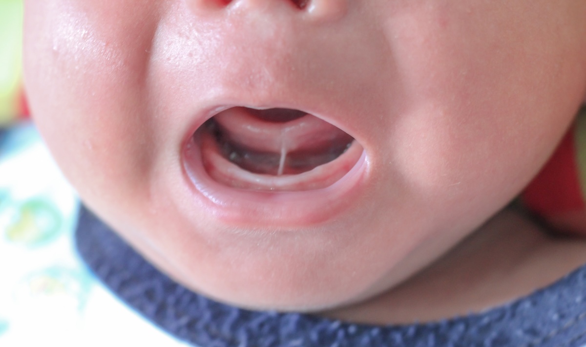 A close-up of a baby’s open mouth showing a visible thin band of tissue under the tongue, which appears to be a tongue-tie (ankyloglossia).