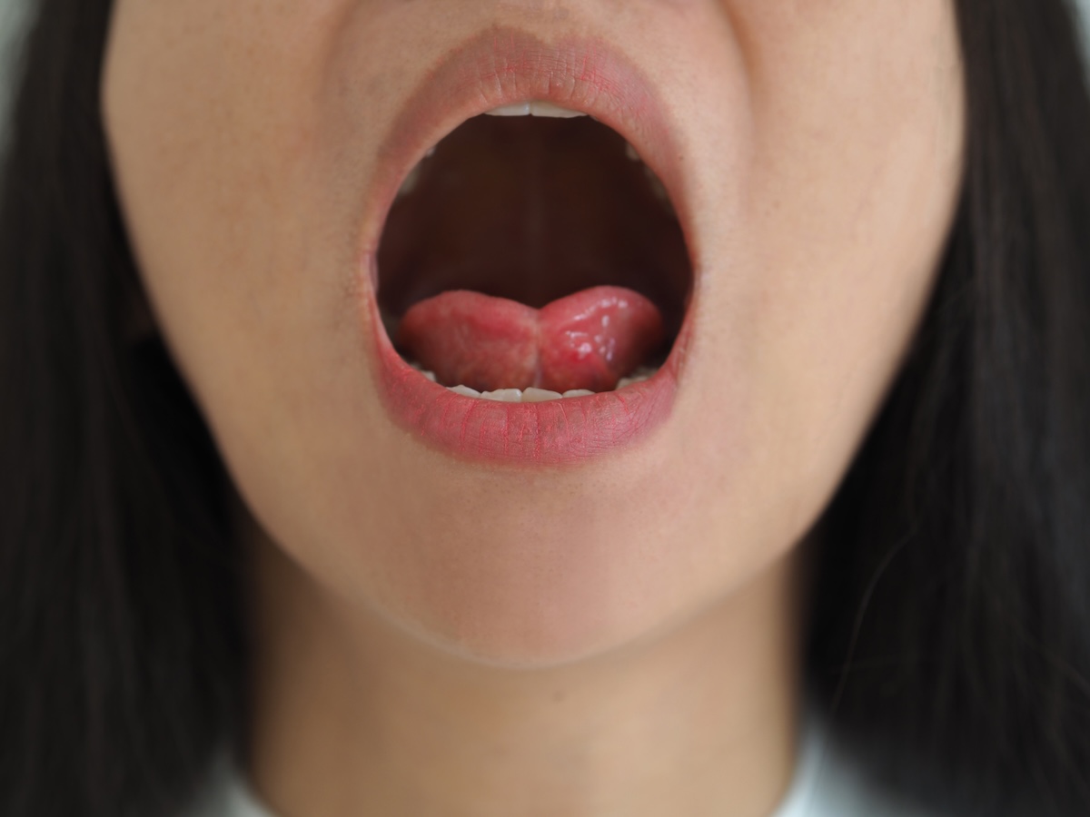 A close-up of a person's open mouth showing a red, swollen bump or sore on the tongue. The lips and part of the chin are visible.