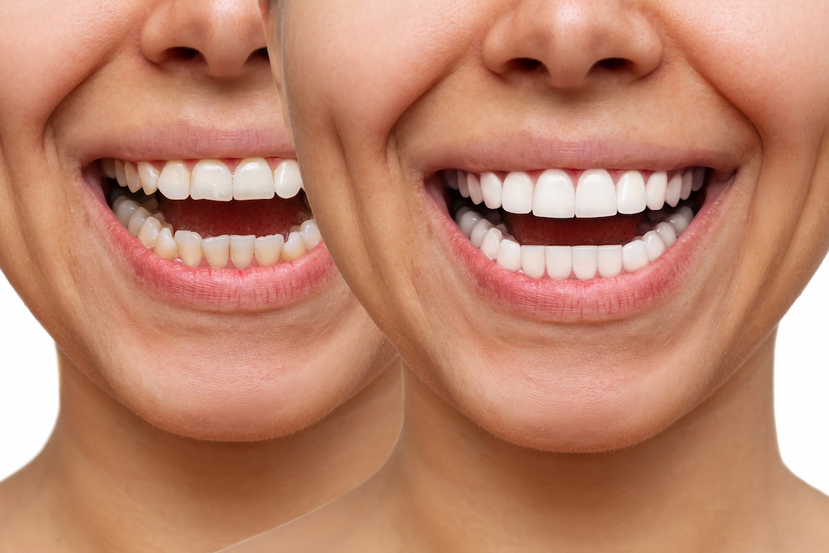 Two close-up shots of a person's mouth smiling; the left shows natural, uneven teeth and the right shows straight, white teeth after veneers