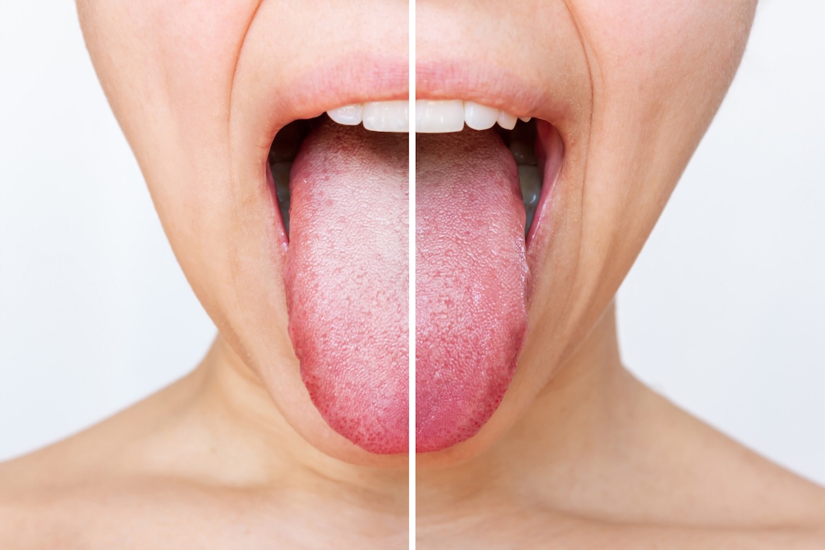 Close-up of a person sticking out their tongue, with the image split in half; the left side shows a white-coated tongue, while the right side shows a healthy pink tongue.