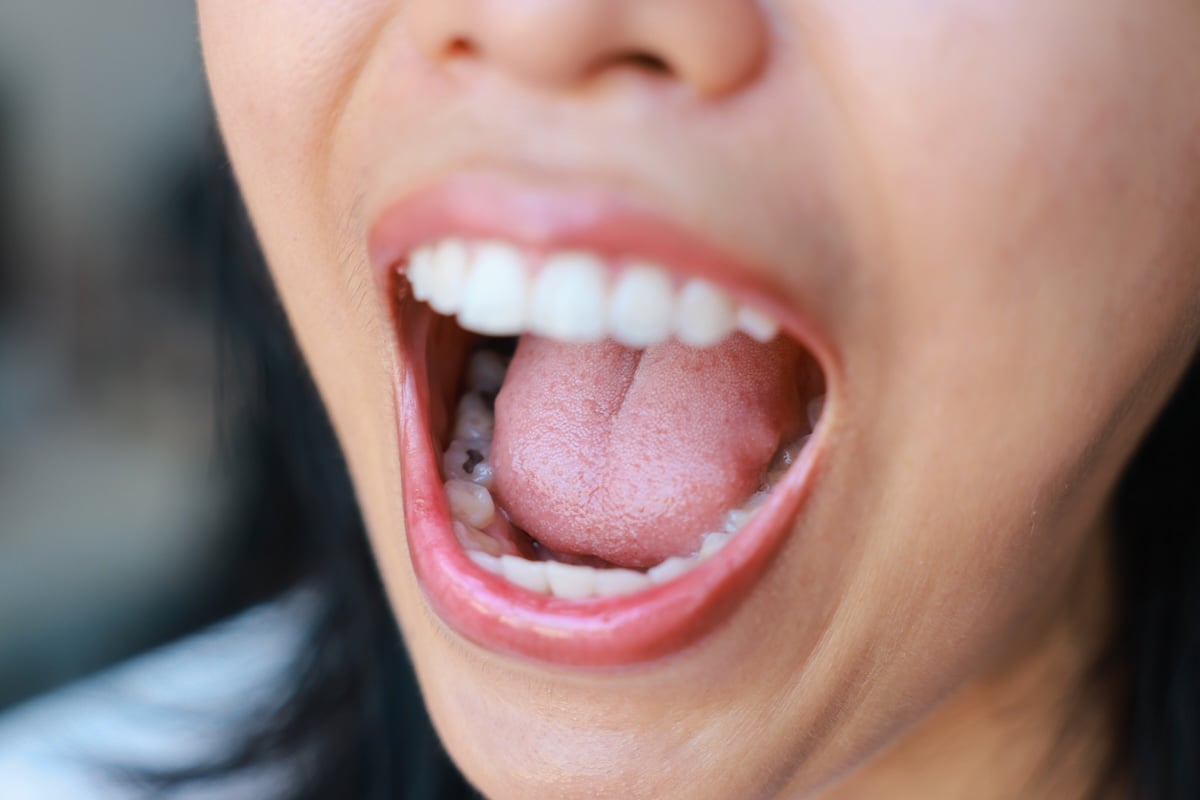 A close-up of a person’s open mouth showing their teeth