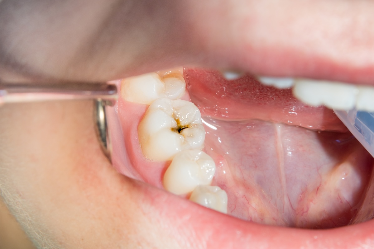 A close-up of an open mouth showing a back molar tooth with a visible dark cavity or decay on the chewing surface