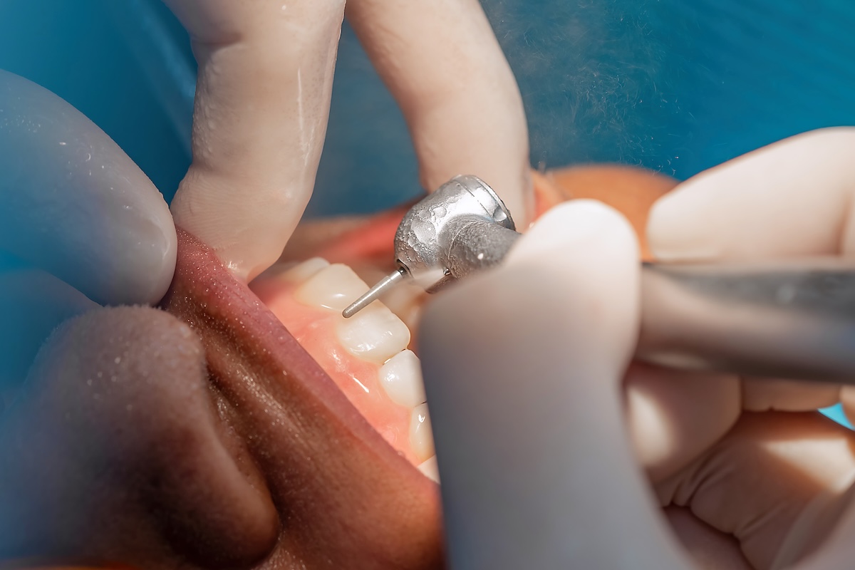 A close-up of a dentist wearing gloves using a dental drill on a patient’s teeth