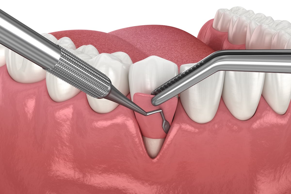 3D illustration showing a dental procedure gum graft
