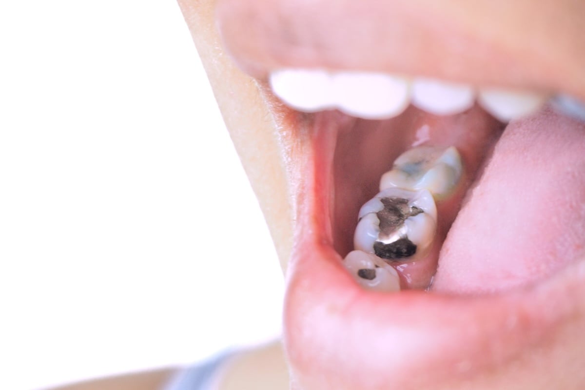 mercury cavity filling on molars