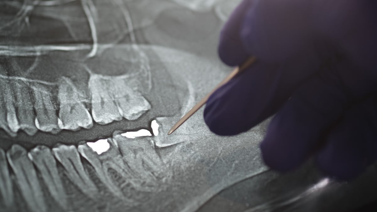 A gloved hand points with a wooden stick at a dental X-ray, highlighting a lower jaw tooth, possibly indicating a problem or area of interest.