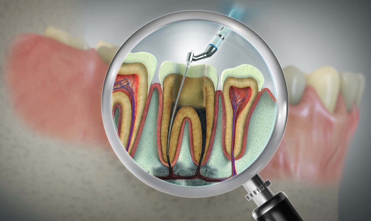 A magnifying glass reveals a detailed cross-section of a tooth undergoing a root canal treatment