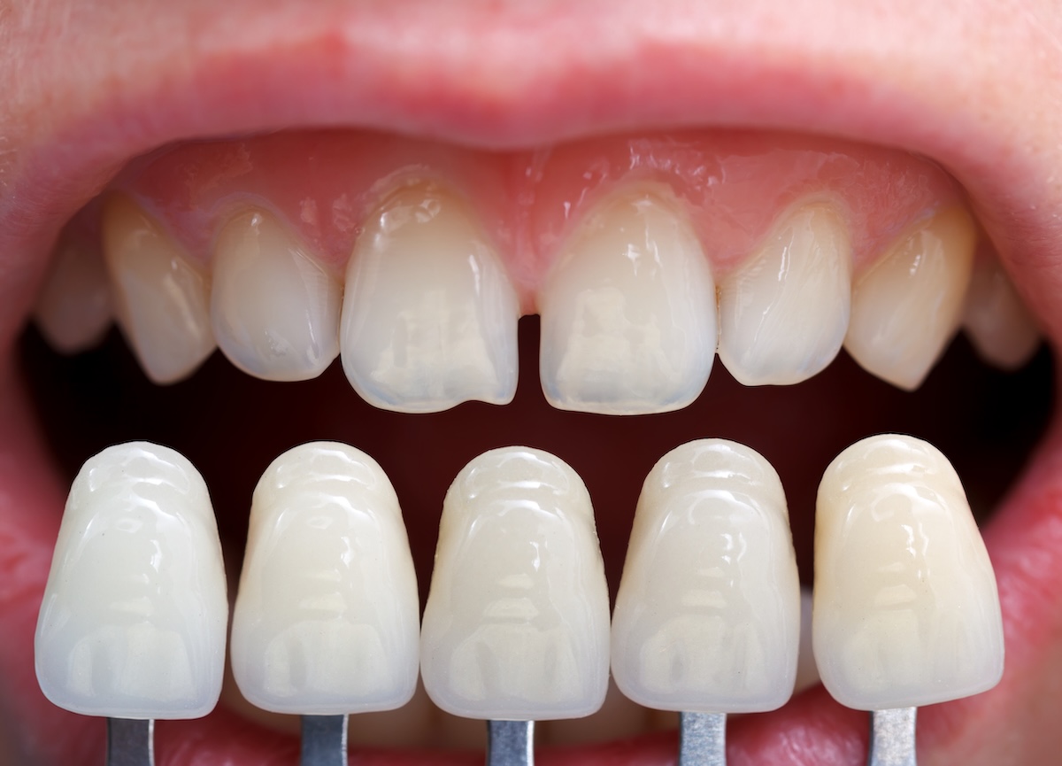 A close-up of a person's open mouth showing their upper front teeth. Below, four dental veneer samples are held up to the teeth for color matching and comparison.