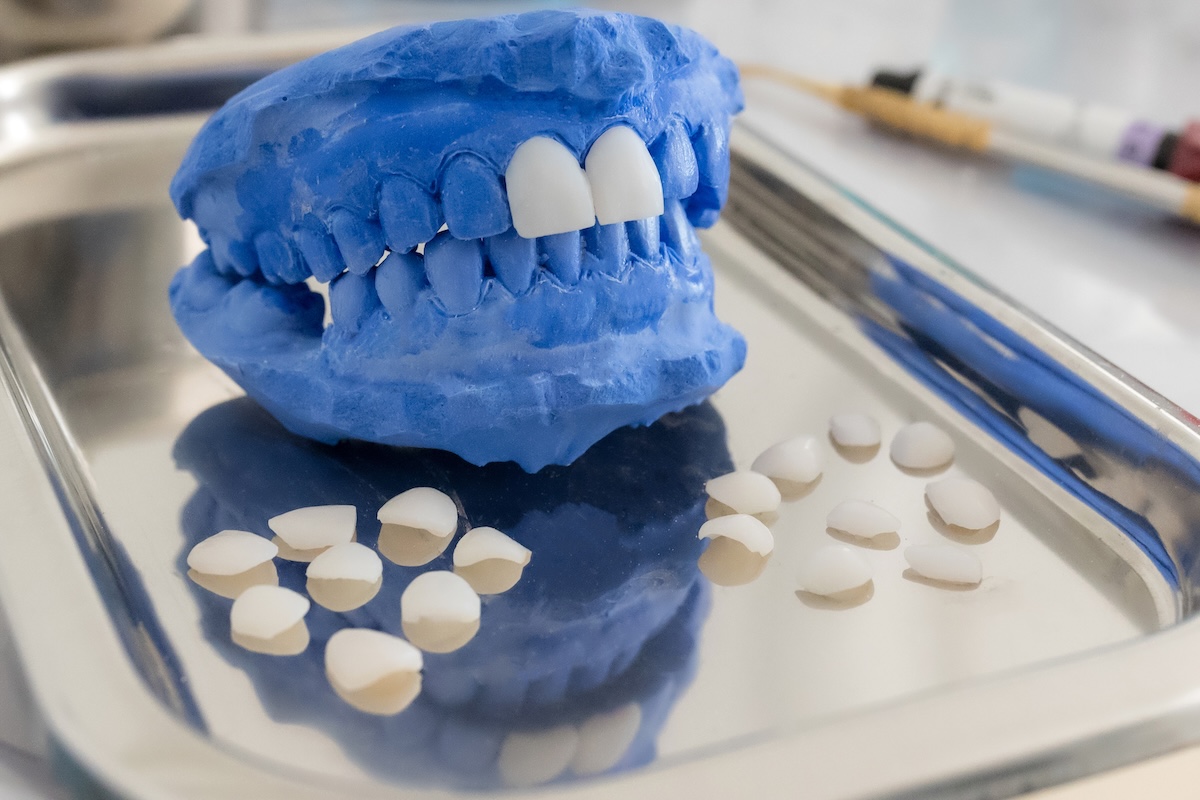 A blue dental mold with white artificial teeth is placed on a metal tray