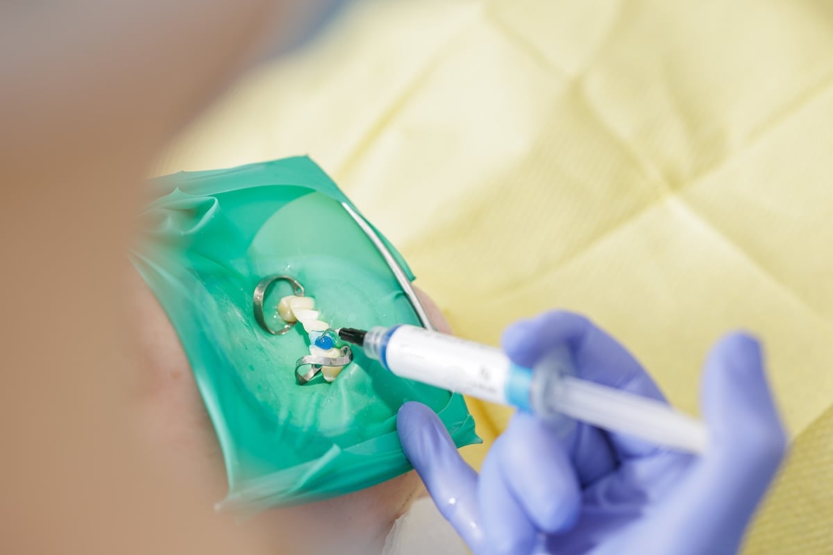 dental bonding