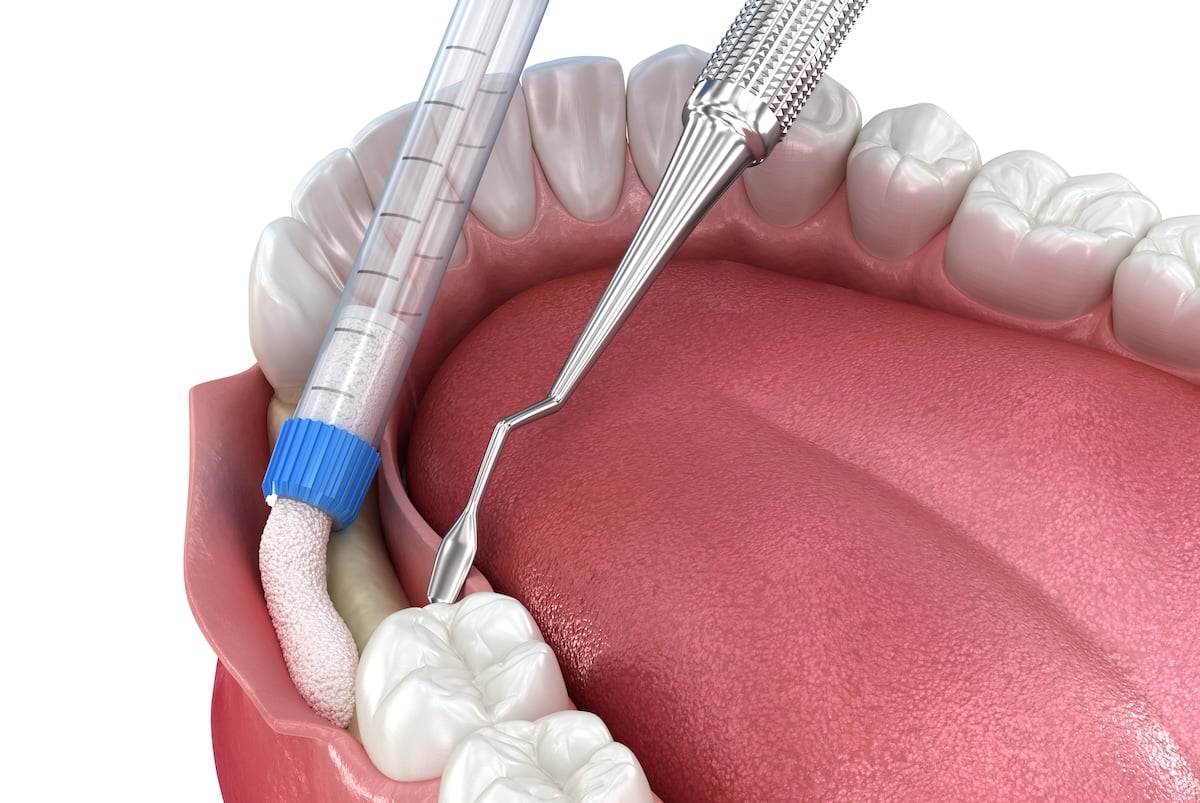 Bone grafting augmentation for tooth implantation.