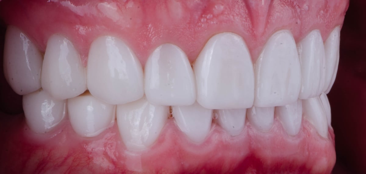 Close-up of a person's mouth showing two rows of clean, white teeth with healthy pink gums, 