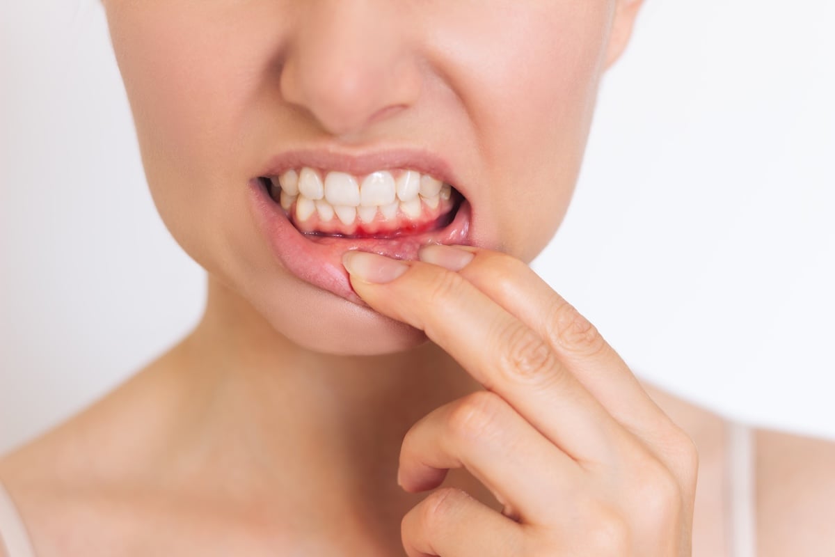 A person pulls down their lower lip with their finger, revealing red, inflamed gums and white teeth