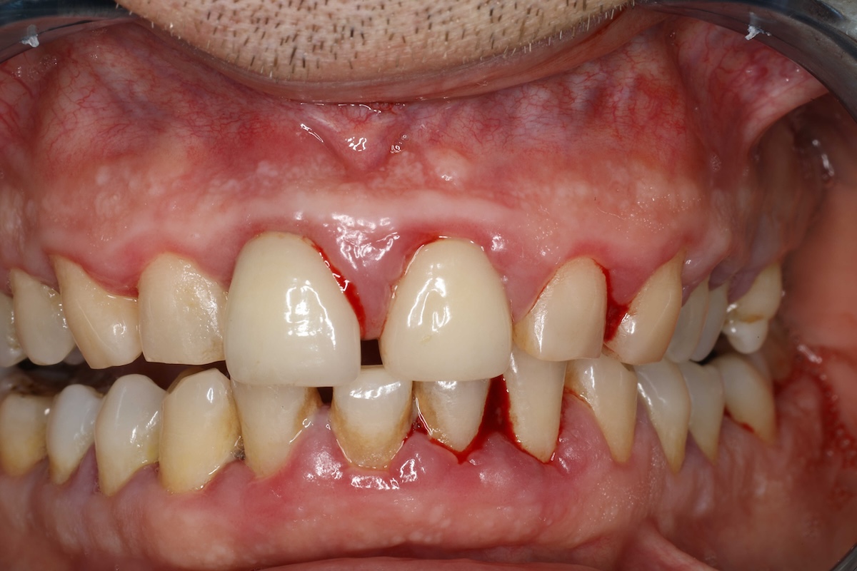 Inflamed bleeding gums